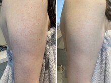 シェリル 松江店(CHARIRE)/ハーブピーリング/毛孔性苔癬