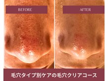 アマテ(Amate)/貴女の毛穴悩みのタイプは？