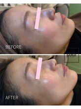 ギルドハナレ(GUILD HANARE)/"光フェイシャル"