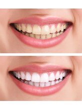 アンジュマリー/☆歯のセルフホワイトニング☆