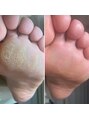 ランカ(RUNKA) 定評のある角質ケア♪しっっかり削らせていただきます!