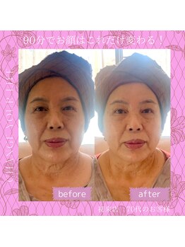 リラブルー(Lilas Bleu)/美禅小顔フェイシャル