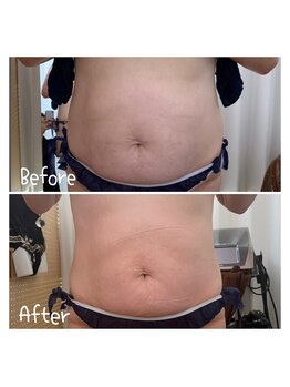 サロンドビオ(Salon de vio)/上半身ラジオスティム