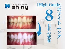 ホワイトニングサロン シャイニー 浜松細島店(shiny)/【超絶・美・白】ホワイトニング