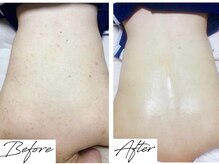 フォトビズの雰囲気（背中ブライダル♪最短で改善していきます！背中ハーブ毛公孔苔癬）