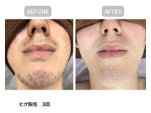 カウピリ(kaupili)/【脱毛】ビフォーアフター