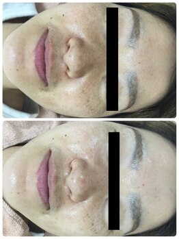 メイユール(MEILLEUR)/光フェイシャル6回