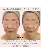 アディス 心斎橋店(ADISE)/エイジングケアハーブピーリング