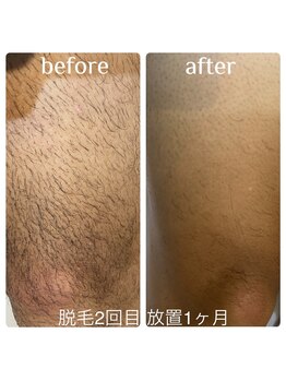 ヨロ 梅郷店(YOLO)/メンズ脱毛