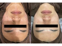 ラヴィアンローズ 泉店 (La vie en Rose)/イロンハーブピーリング