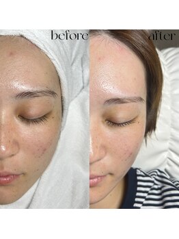 エルミュ(Elmu)/韓国美肌ワックス脱毛