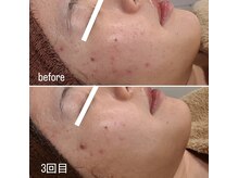 シス(SiS.)/ハーブピーリング月１ペース