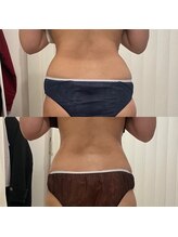 エルベ(ellbe)/痩身【腰回り、浮き輪肉】