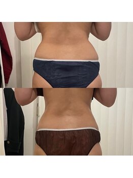 エルベ(ellbe)/痩身【腰回り、浮き輪肉】