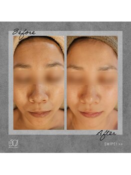 ゴーマルイチ(501)/光フェイシャル Before/After