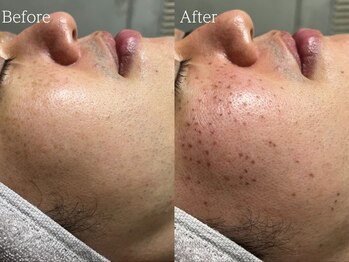 ルミナ シブヤ(LUMINA SHIBUYA)/【男性】シミケア1回