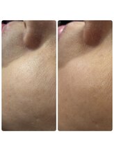 スキンラボ カホクカイ(KaHokuKai)/初回