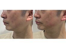 スキンスタジオ レア(Lea)/韓国オンダリフト