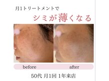 エーサロン(A-Salon)/【エンビロン】シミケア