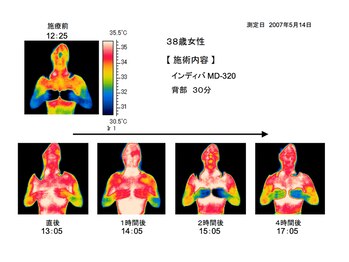 バックステージ鍼灸院(Backstage鍼灸院)/深部加温のインディバ