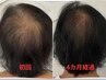 50代60代でも加齢による育毛を促すサポートコース