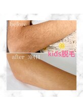 ナンバー511(No.511)/キッズ脱毛