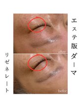 モンクラッシー(Mon classy)/一度の施術直後