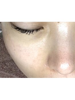 シミしわ改善！予防ケア