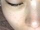 エマ(emma)の写真/大人女性の肌悩み/毛穴やシワでお悩みの方に◎フェイシャルWAX×韓国ハーブピーリングでお肌の悩みを改善♪