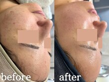 ボニータアンジュ 恵比寿(Bonita Ange)/渋谷ハーブピーリング｜症例