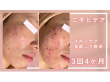 シャルナ(charna)/ニキビケア