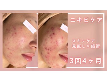 シャルナ(charna)/ニキビケア