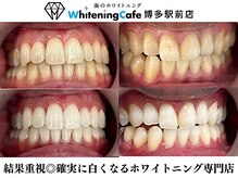 ホワイトニングカフェ 博多駅前店(WhiteningCafe)