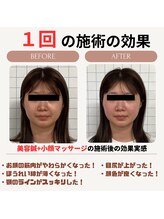 クローバー鍼灸整骨院/美容鍼＋小顔矯正マッサージ