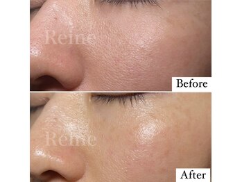 レーヌ(Reine)/白玉ピコジェット＋臍帯原液導入