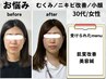 人気No.1小顔×透明感UP！美容鍼×フェイシャル×ヘッドスパ×美顔器￥15000