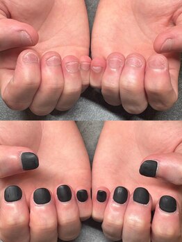 キレイファクトリー/メンズ 深爪矯正