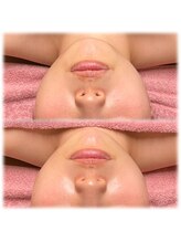 ヴィーナス(Venus)/IPL光フェイシャル