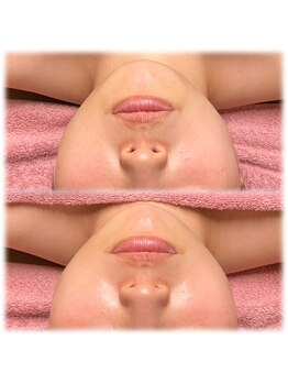 ヴィーナス(Venus)/IPL光フェイシャル