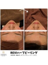 アクシア ビューティー サロン(AXSIA)/【ハーブピーリング】