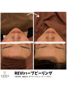 アクシア ビューティー サロン(AXSIA)/【ハーブピーリング】