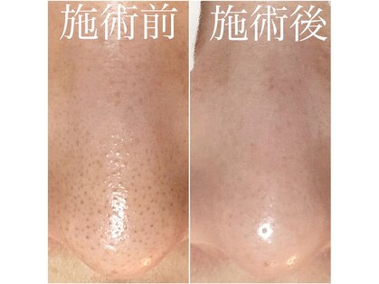 毛穴塾の写真