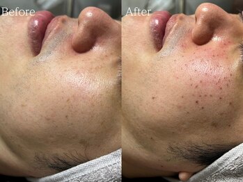 ルミナ シブヤ(LUMINA SHIBUYA)/【男性】シミケア1回