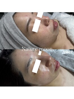ナチュールムーン(Nature moon.)/ハーブピーリング