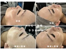 ウルト アルティメイトスキン(ULT ultimate skin)/ララピールのbefore after