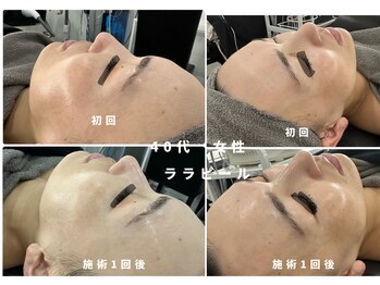 ウルト アルティメイトスキン(ULT ultimate skin)/ララピールのbefore after