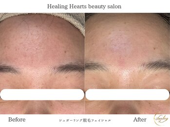 ヒーリングハーツ(Healing Hearts)/フェイシャルシュガーリング♪