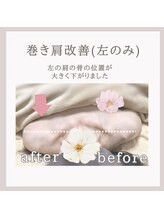 アリサナ(Arisana)/症例写真　巻き肩調整　