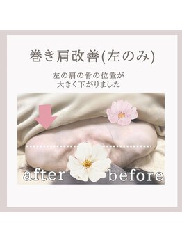 アリサナ(Arisana)/症例写真 巻き肩調整