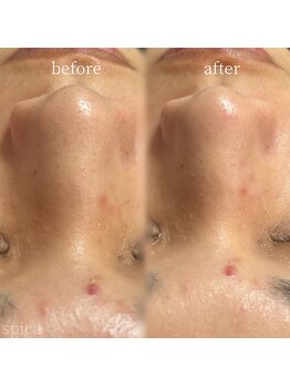 スピカ(Spica)/毛穴の黒ずみスッキリ♪